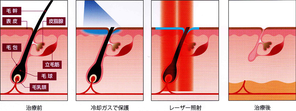 治療前・冷却ガスで保護・レーザー照射・治療後のイメージイラスト